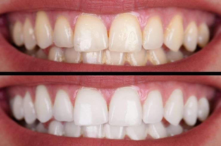 teeth whitening